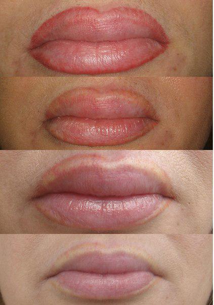 удаление татуировок